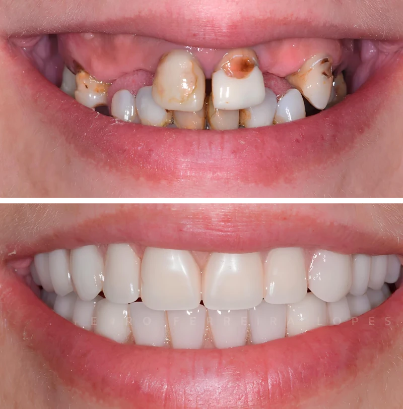 Dentadura de Silicone FIX Ajustável e Adaptativa